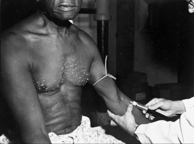 tuskegee injection